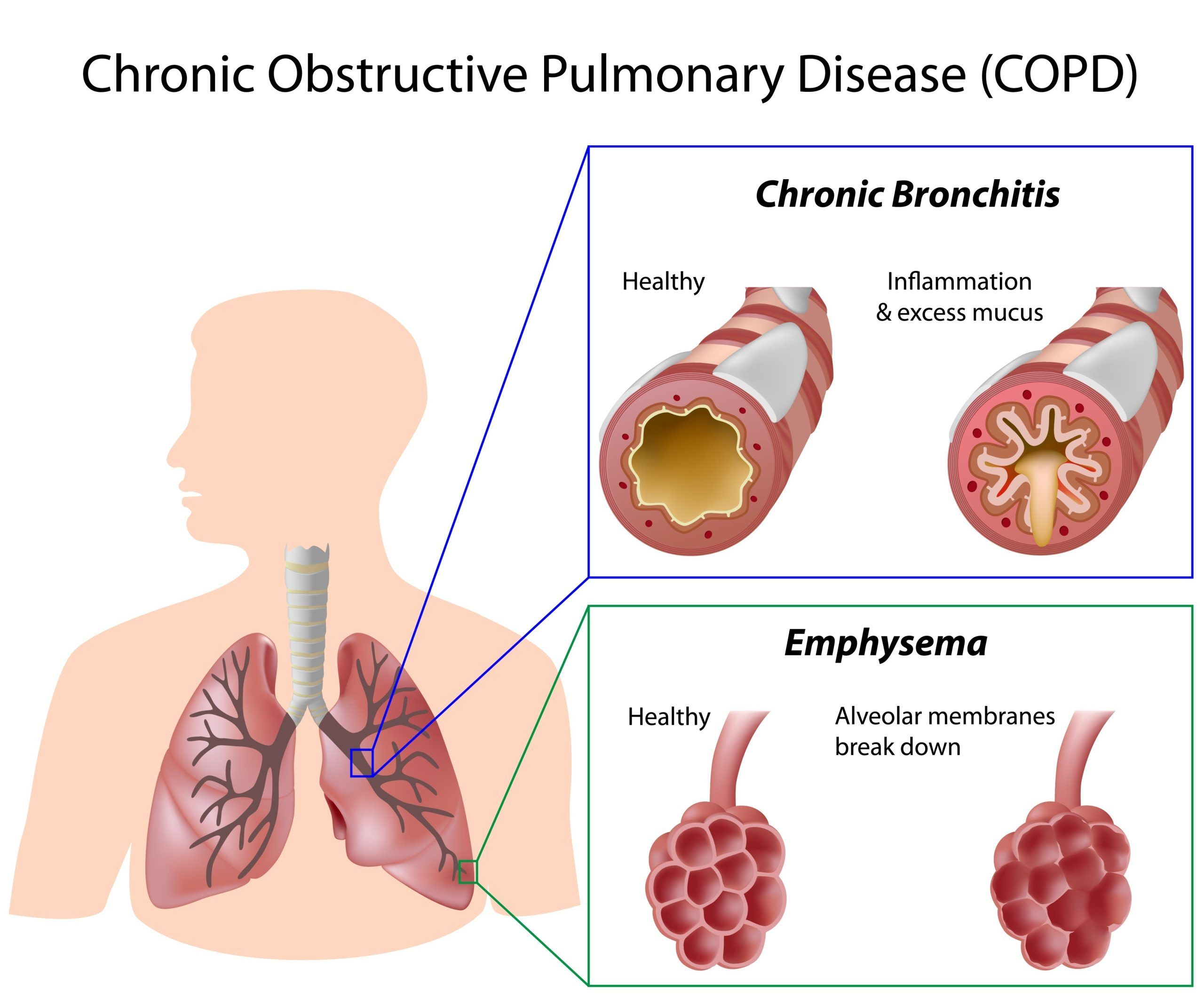 Advice for people with COPD
