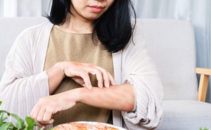 A woman with black hair sits at a table with a plate of prawns. She is scratching her arm, which appears to have some discoloration due to whatever is irritating her skin.