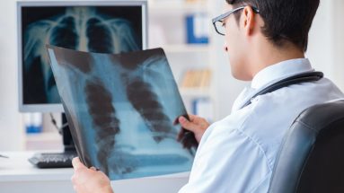 A man who is in a white coat looks at a chest x-ray. The photo is taken over his shoulder and the emphasis on the image is the chest x-ray. There is also another chest x-ray image on the left wall.