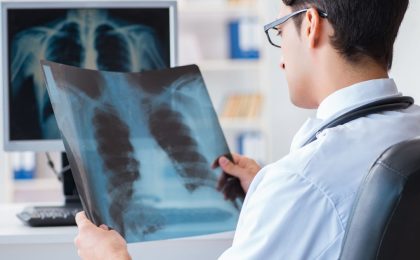 A man who is in a white coat looks at a chest x-ray. The photo is taken over his shoulder and the emphasis on the image is the chest x-ray. There is also another chest x-ray image on the left wall.